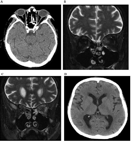 Figure 1 From A Fatal Case Of Acute Bilateral Orbital Apex Syndrome