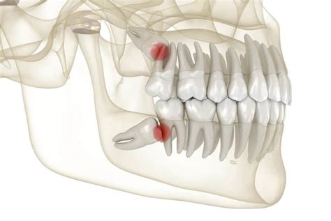 Inferior Alveolar Nerve Injury During Wisdom Tooth Extraction Med