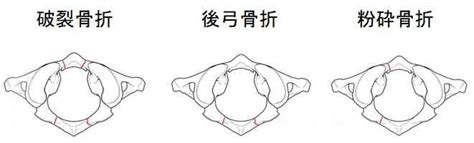 頚椎骨折分類: 大腿骨頸部骨折 生命予後 : 頸椎骨折分類 – UROTAM