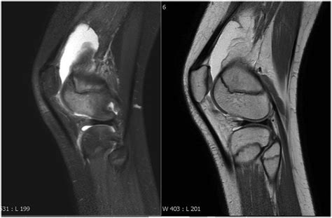 Irresti Cortical Desmoid Knee Mri