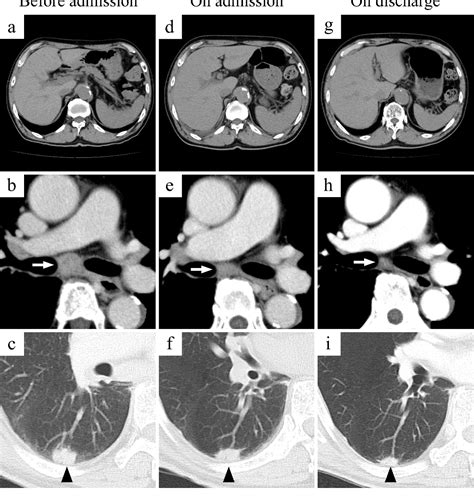 Figure From Hemophagocytic Lymphohistiocytosis In A Patient With