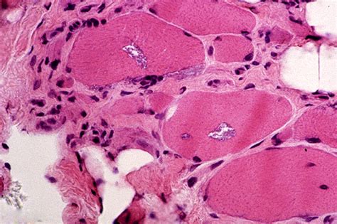 Dermatomyositis Histology