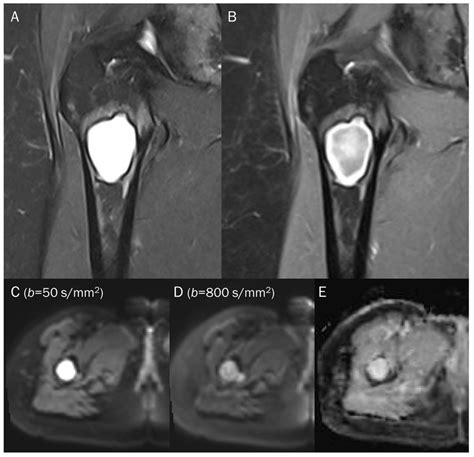 Diagnostics Free Full Text Pitfalls Of Diffusion Weighted Imaging