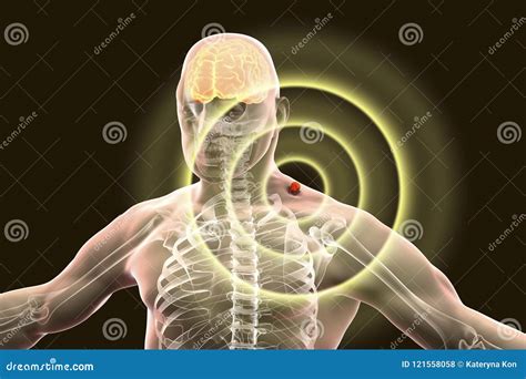 Tick-borne Encephalitis Concept Stock Illustration - Illustration of ...