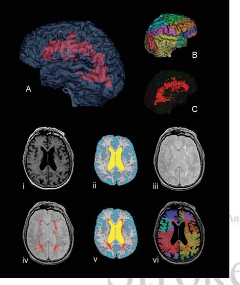 Figure 1 From Misclassified Tissue Volumes In Alzheimer Disease