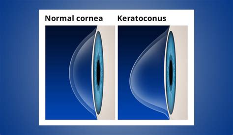 Scleral Contact Lenses Keratoconus