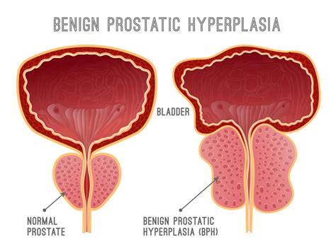 Benign Prostatic Hyperplasia Bph