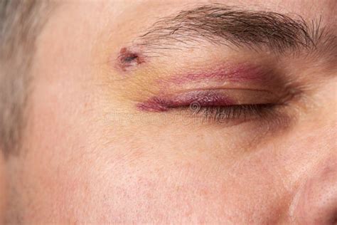 Close View of a Black Eye, Man`s Face with a Hematoma Stock Image ...