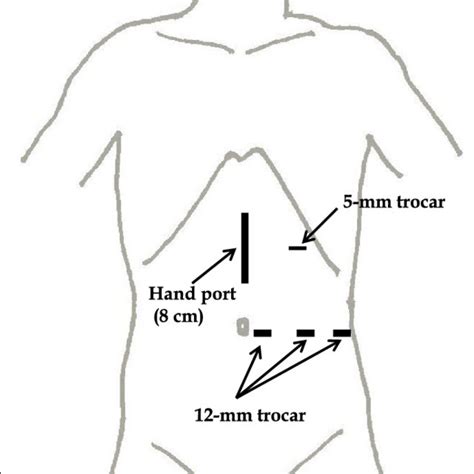 Skin Incision And Port Placement Of Hand Assisted Laparoscopic