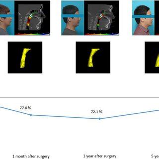 Sequential Changes In Airway Volume Following Orthognathic Surgery