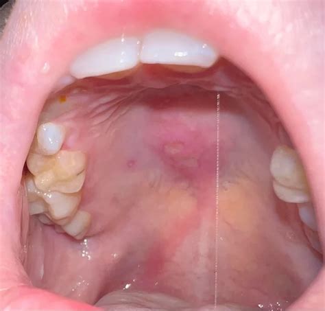 Canker Sore Roof Of Mouth