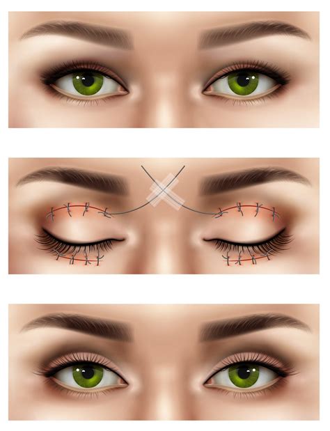 Title Understanding Blepharoplasty A Comprehensive Guide