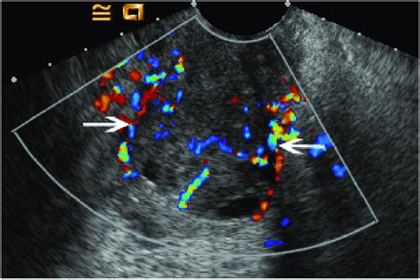 Color Doppler Evaluation Of Cervical Carcinoma Transverse Transvaginal