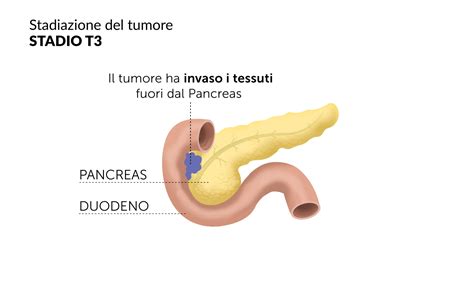 Stadi tumore pancreas classificazione operabilità metastasi