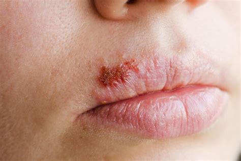 G Rtelrose Herpes Zoster Symptome Ursachen Behandlung