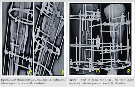 Case Of Infected Non Union Of Distal Femur Treated With Ilizarov