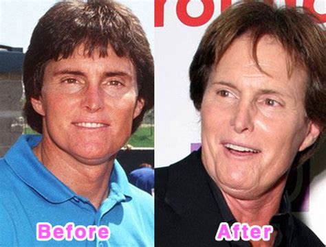 Celebrity Plastic Surgery Disasters Before And After 16 Pics