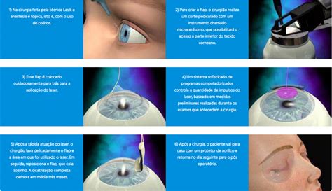 Cirurgia Refrativa Laser LASIK iLASIK e PRK CLÍNICA TIJUCAS