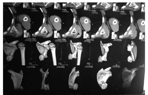 Preoperative Computed Tomography Scan With 3 Dimensional Reconstruction Download Scientific