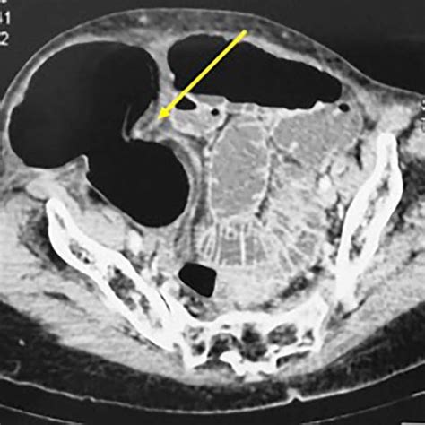 Abdominal CT Scan Showing A Strangulated Right Spigelian Hernia With