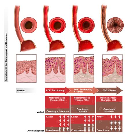 Illustration eosinophilic esophagitis - MedicalGraphics