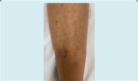 Photo of surgical scar from old pin site infection on acute ...