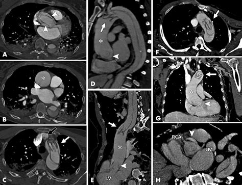 Intimointimal Intussusception In Acute Aortic Dissection Radiology