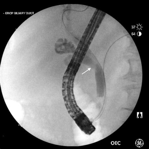 ERCP Revealing A Filling Defect White Arrow Consistent With A Stone