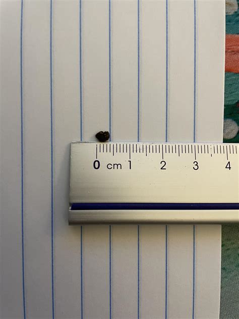 Kidney stones and indigestion, abdominal bloating, gas pain? : r