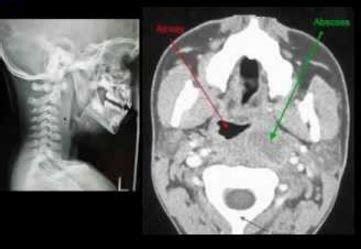 Retropharyngeal Abscess - Pictures, X-Ray, Treatment, Symptoms