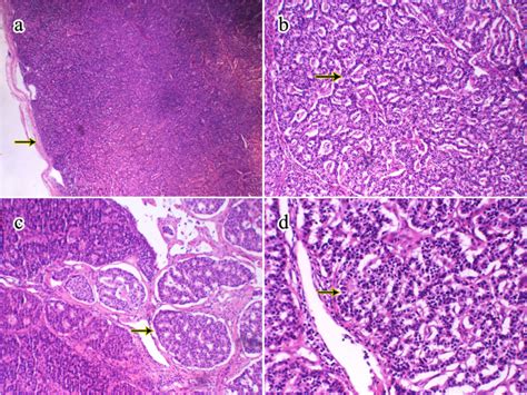 A Primary Neuroendocrine Tumor Of The Left Ventricle Presenting With