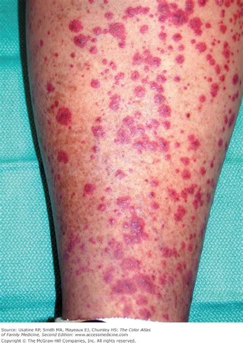 Hypersensitivity Vasculitis