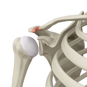 Acromioclavicular (AC) Joint Osteoarthritis | Advanced Orthopaedics ...