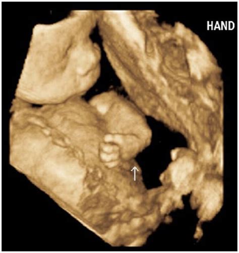 Prenatal Sonographic Detection Of Multiple Congenital Anomalies A Case