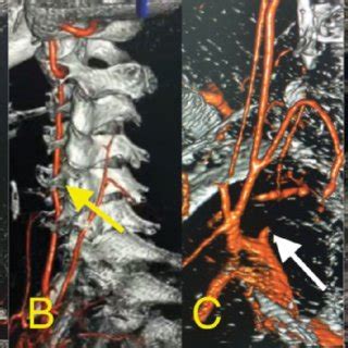 Pdf Bilateral Vertebral Artery Dissection After A Chiropractic