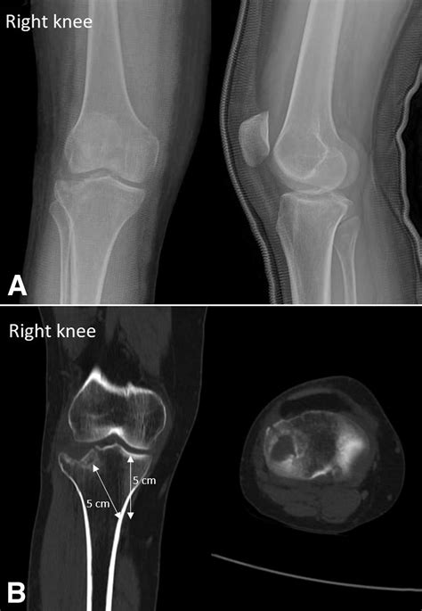 Arthroscopic Assisted Reduction Of Depressed Lateral Tibial Plateau