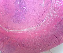 Neuroendocrine Tumour Of The Appendix Libre Pathology