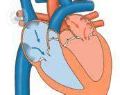 Soplos en el corazón causas y tratamiento Cardiólogo Málaga Top