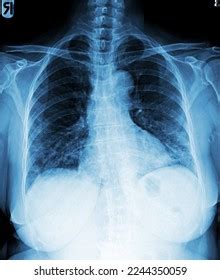 Film Chest Xray Pa Upright Show Stock Photo Shutterstock