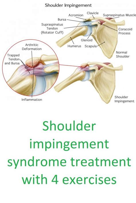 Shoulder Impingement Syndrome Treatment With 4 Exercises Artofit