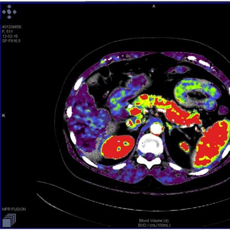 Perfusion Ct Roi Positioning In Pancreatic Tail Download Scientific