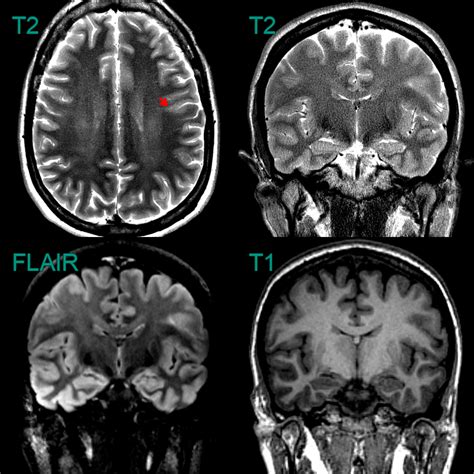 Focal Cortical Dysplasia Fcd Neuroradiology