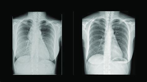 Figure E Preoperative Left And Postoperative Right Radiographs Of