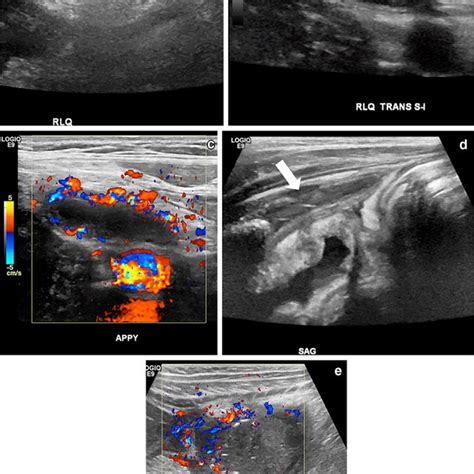 Suspected Pediatric Appendicitis Clinical Pathway Or Operating Room Download Scientific