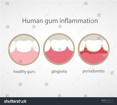 Human Gum Inflammation Eps 10 Vector File 262834178 Shutterstock