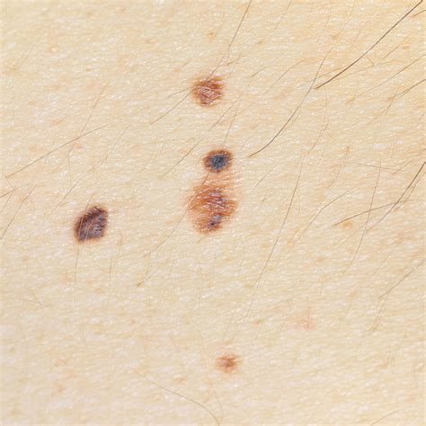 Removing Moles at Home Can Be Dangerous - Mayoral Dermatology