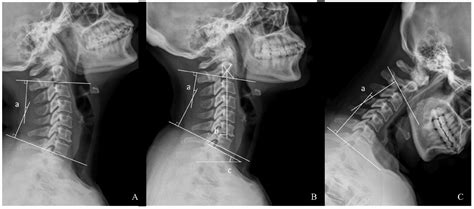 Normal Flexion Extension Cervical Spine X Rays Mensproperties