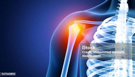 Human Shoulder Joint Pain Xray View Shoulder Ligament Tendinitis Shoulder Muscle Strain 3d