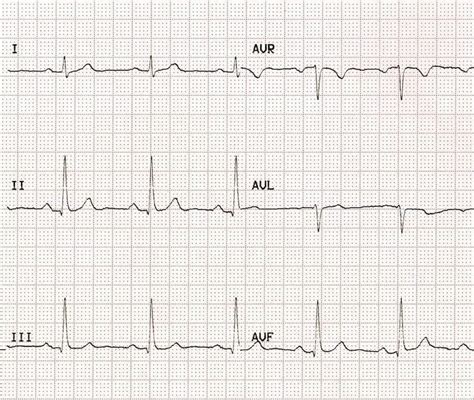 Lead reversal: Left arm/right arm • LITFL • ECG Library Diagnosis