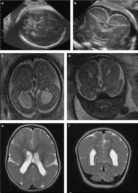 Lissencephaly Type I Prenatal And Postnatal Imaging Three Different